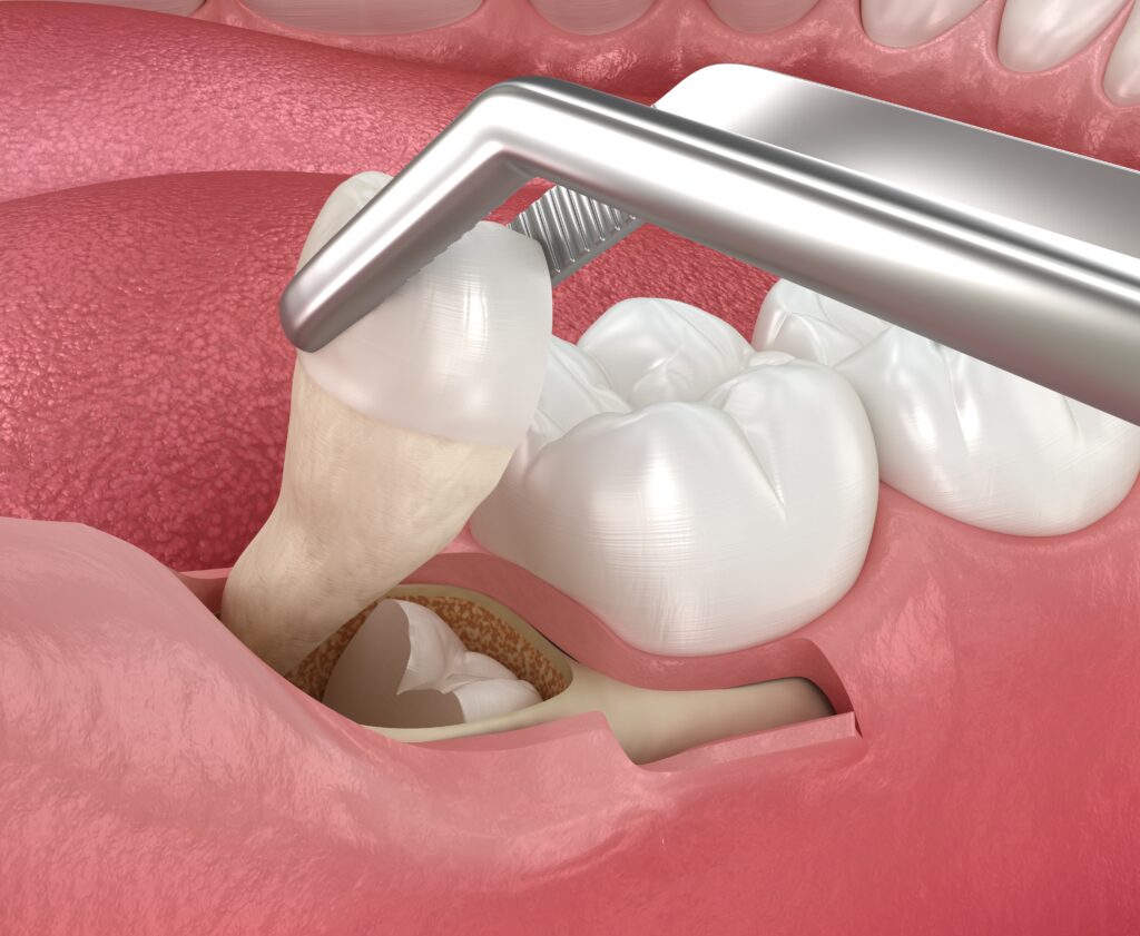 wisdom teeth extractions Edmond