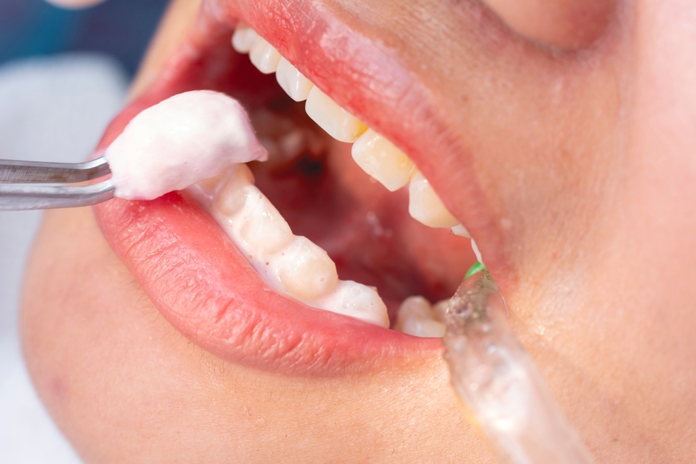 Fluoride Treatment Edmond