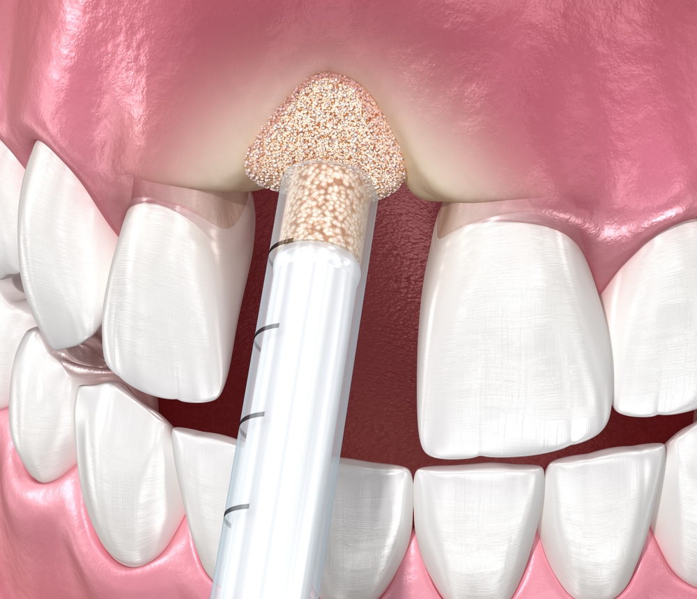 Bone Grafting edmond